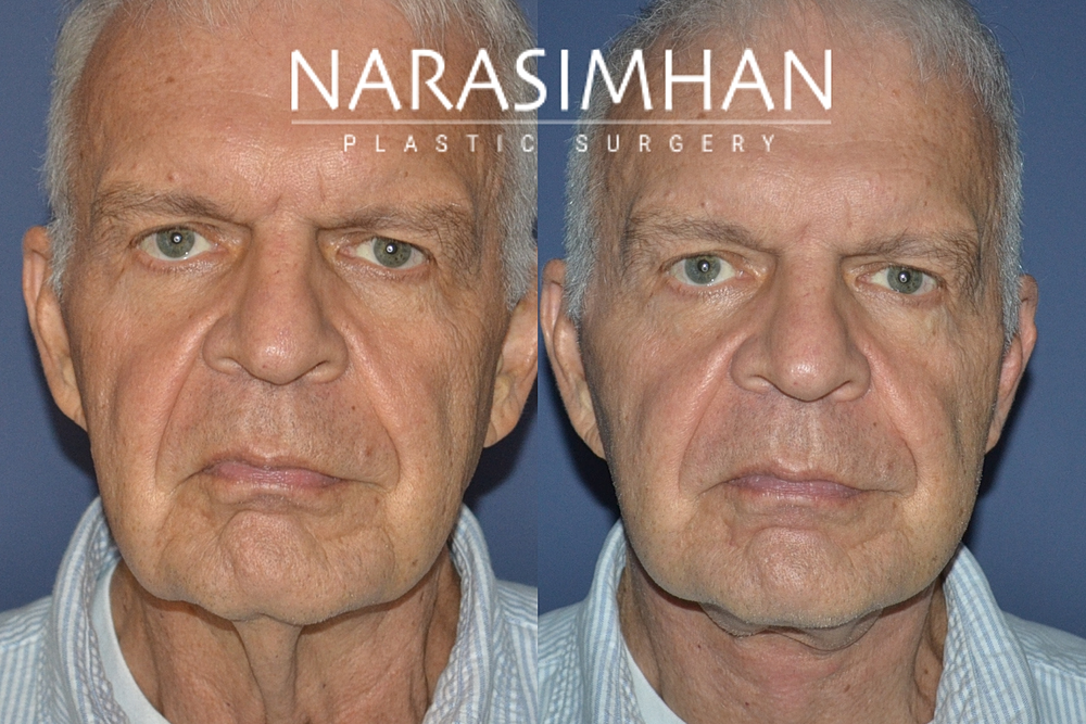 Neck Lift Before & After