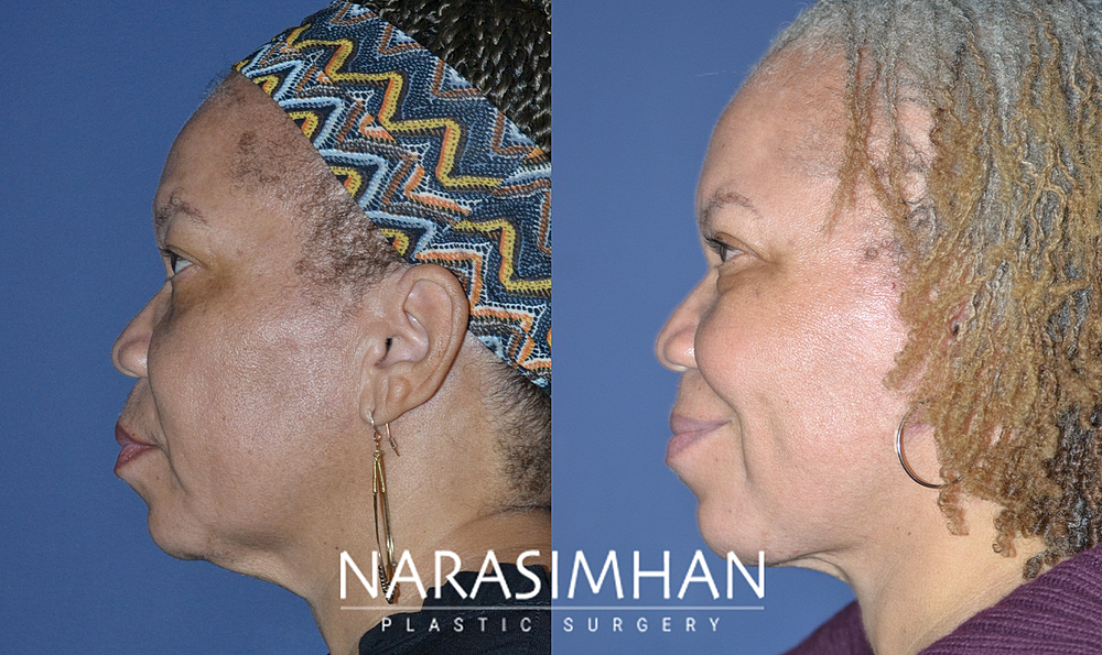 Neck Lift Before & After