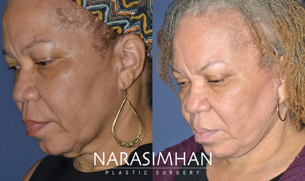 Neck Lift Before & After
