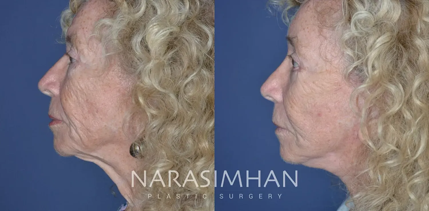 Neck Lift Before & After
