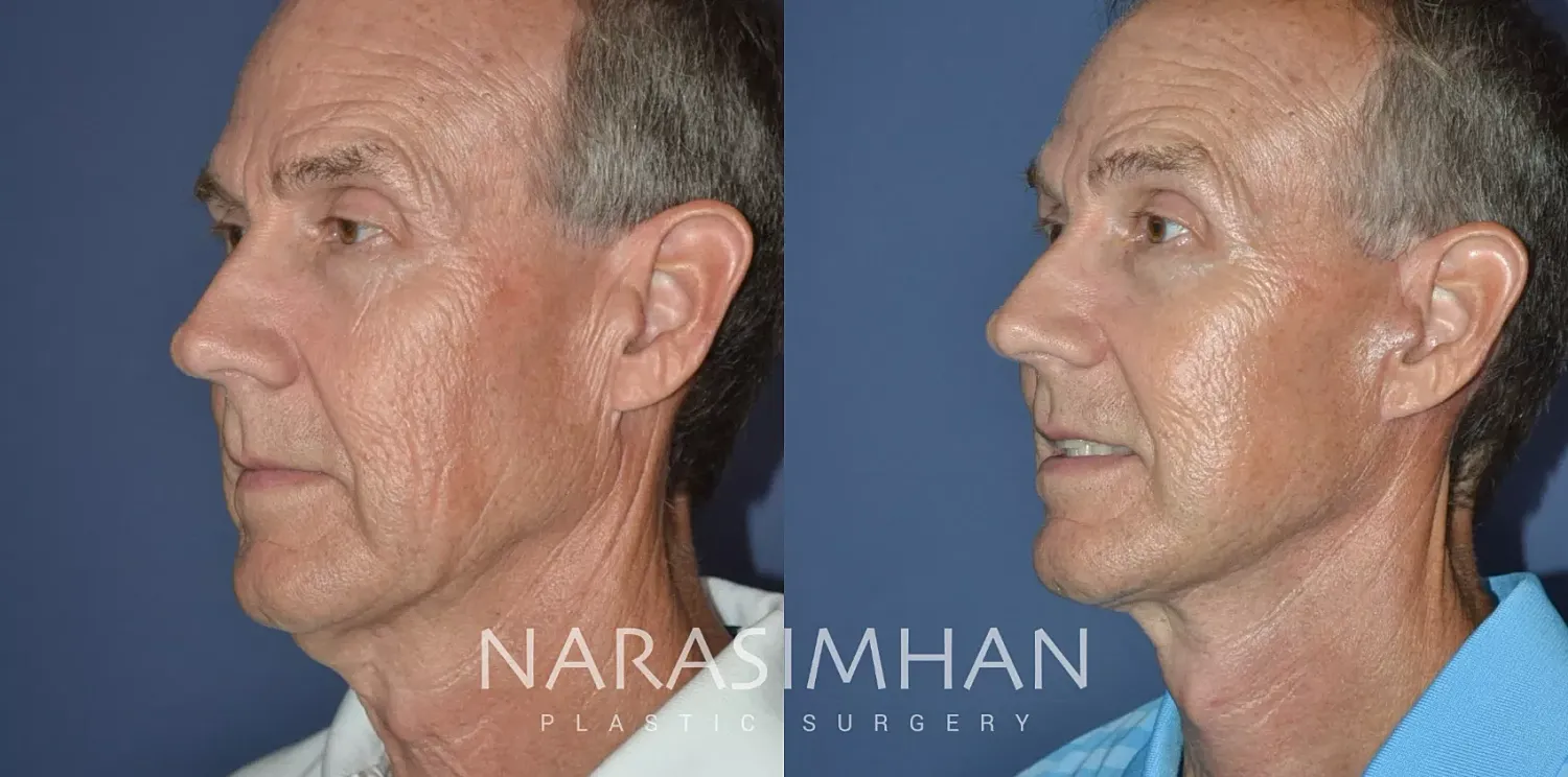 Neck Lift Before & After