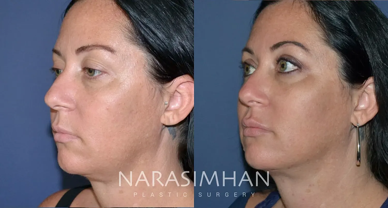 Neck Lift Before & After