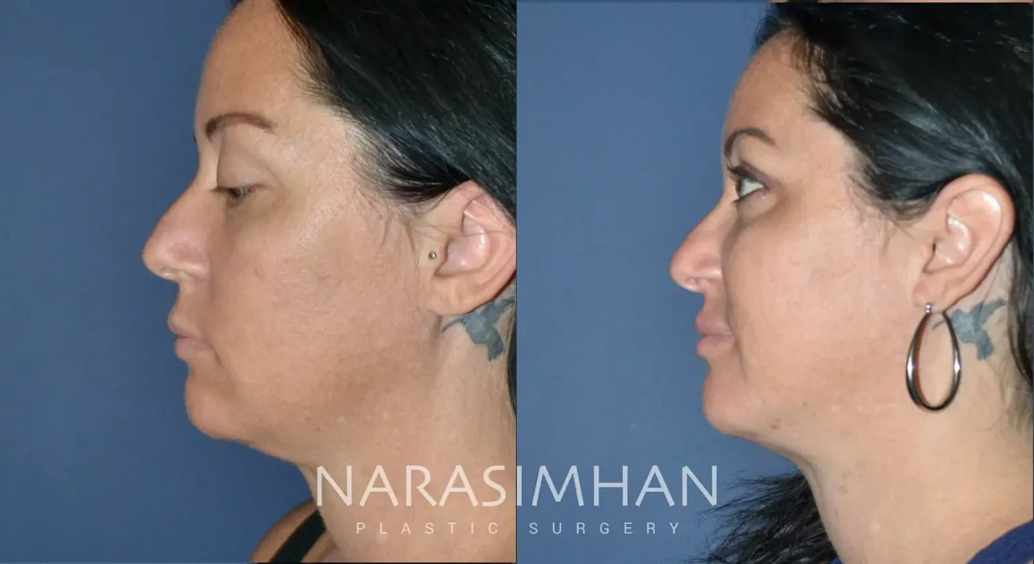 Neck Lift Before & After