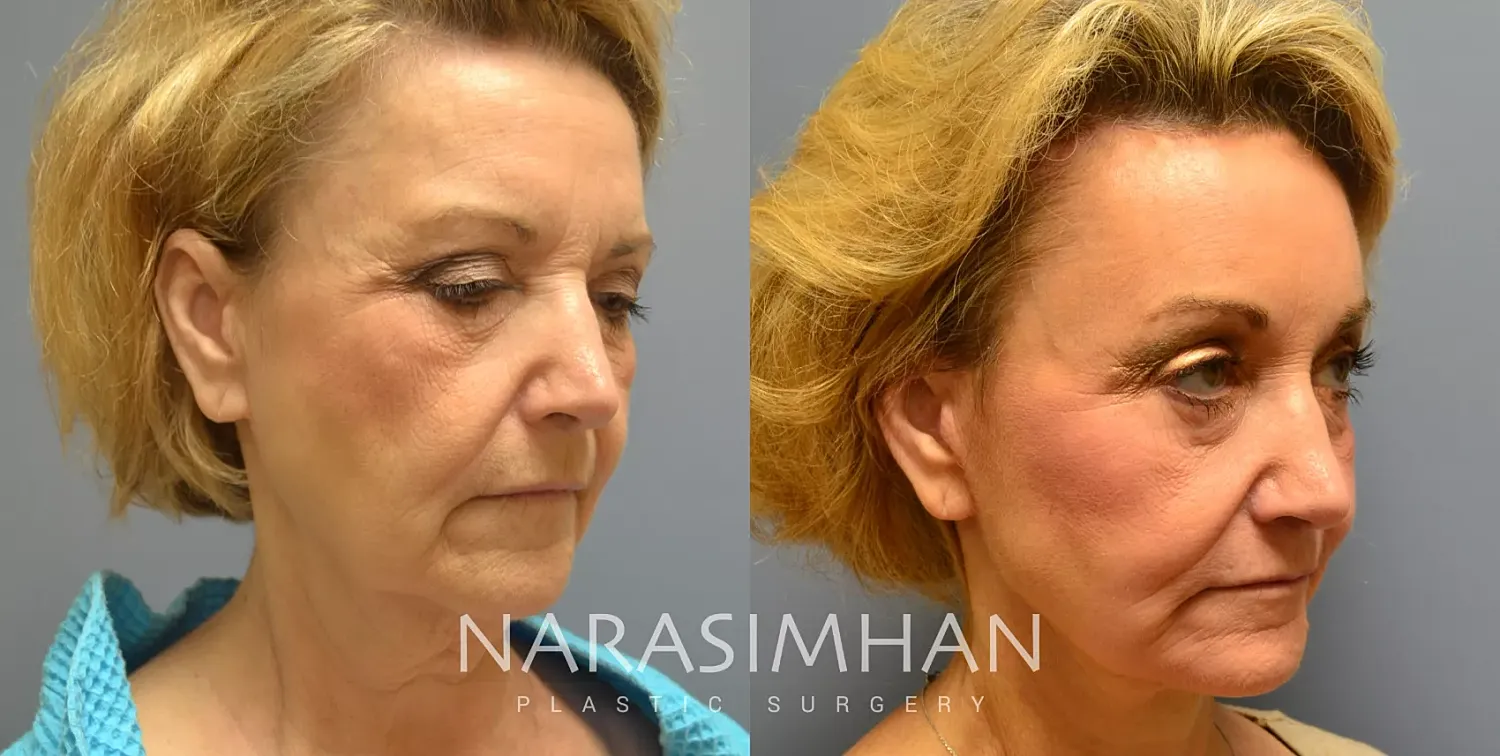 Neck Lift Before & After