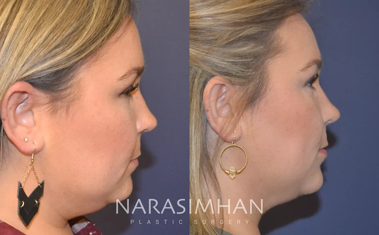 Neck Lift Before & After