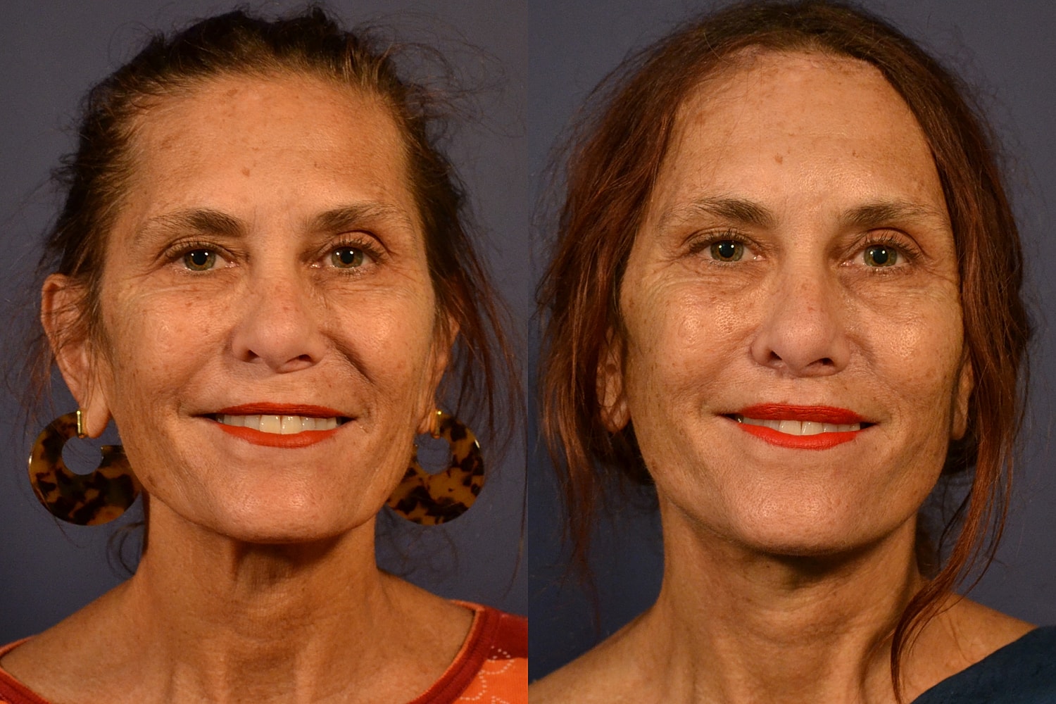 Facelift Before & After