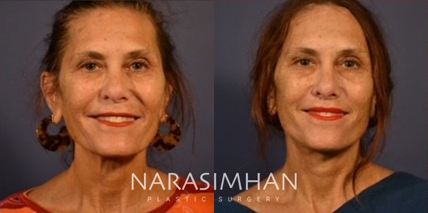 Facelift Before & After