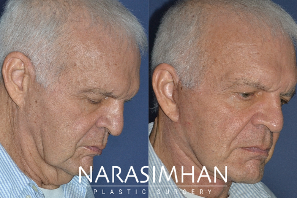 Facelift Before & After