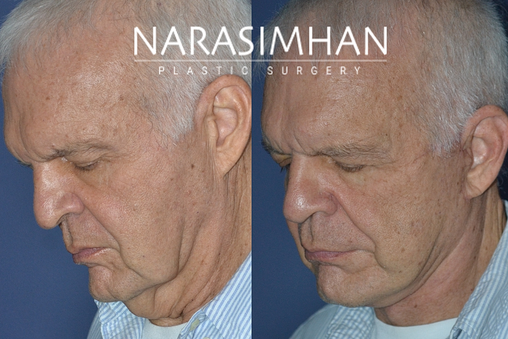 Facelift Before & After