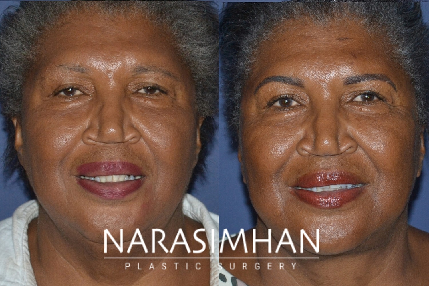 Facelift Before & After