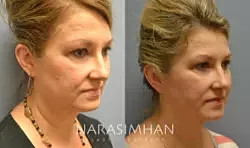 Facelift Before & After