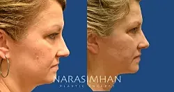 Facelift Before & After