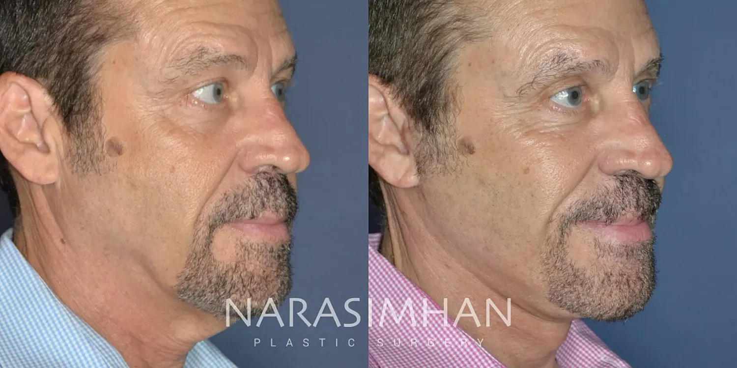 Facelift Before & After
