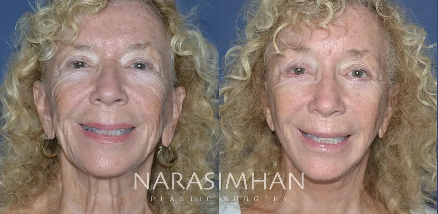 Facelift Before & After