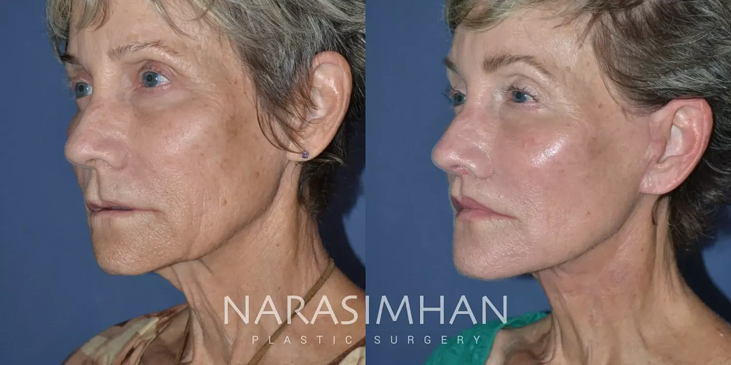 Facelift Before & After