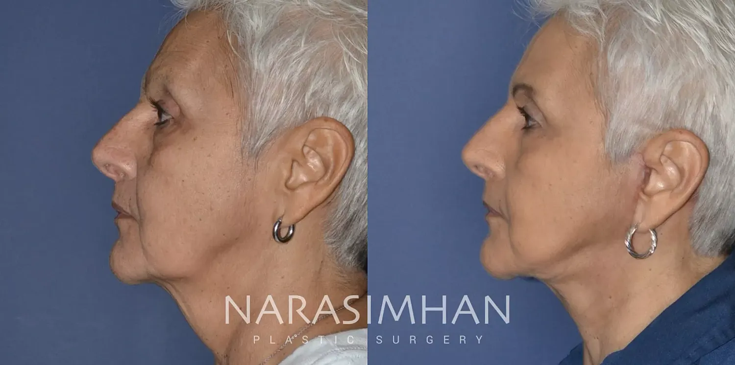 Facelift Before & After