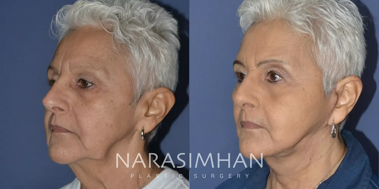 Facelift Before & After