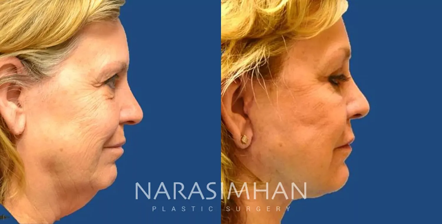 Facelift Before & After