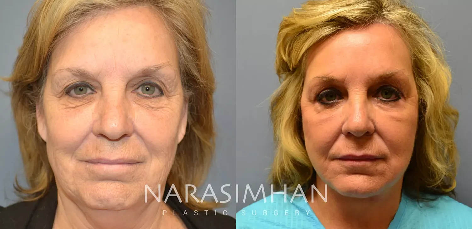 Facelift Before & After