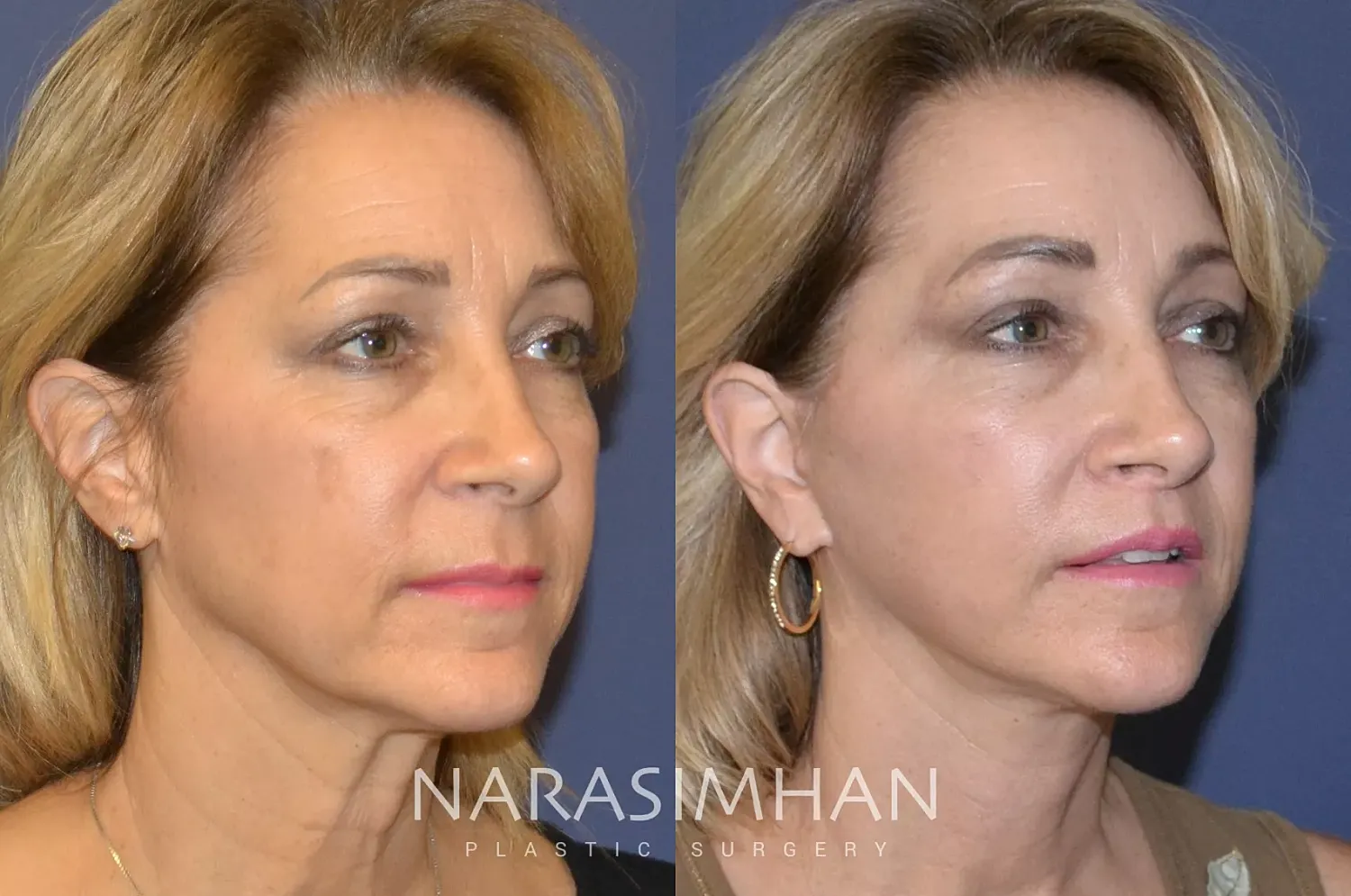 Facelift Before & After
