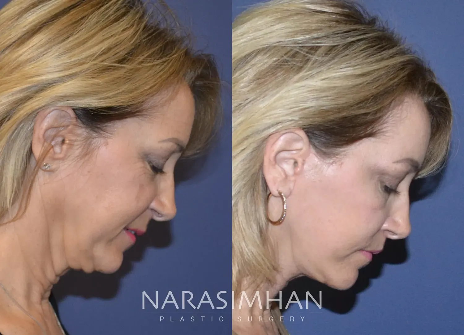 Facelift Before & After