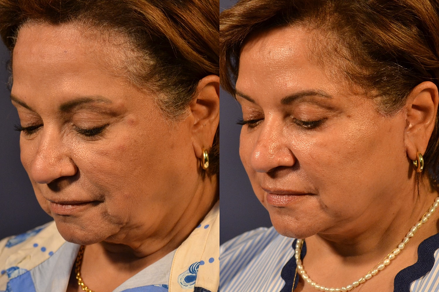 Facelift Before & After