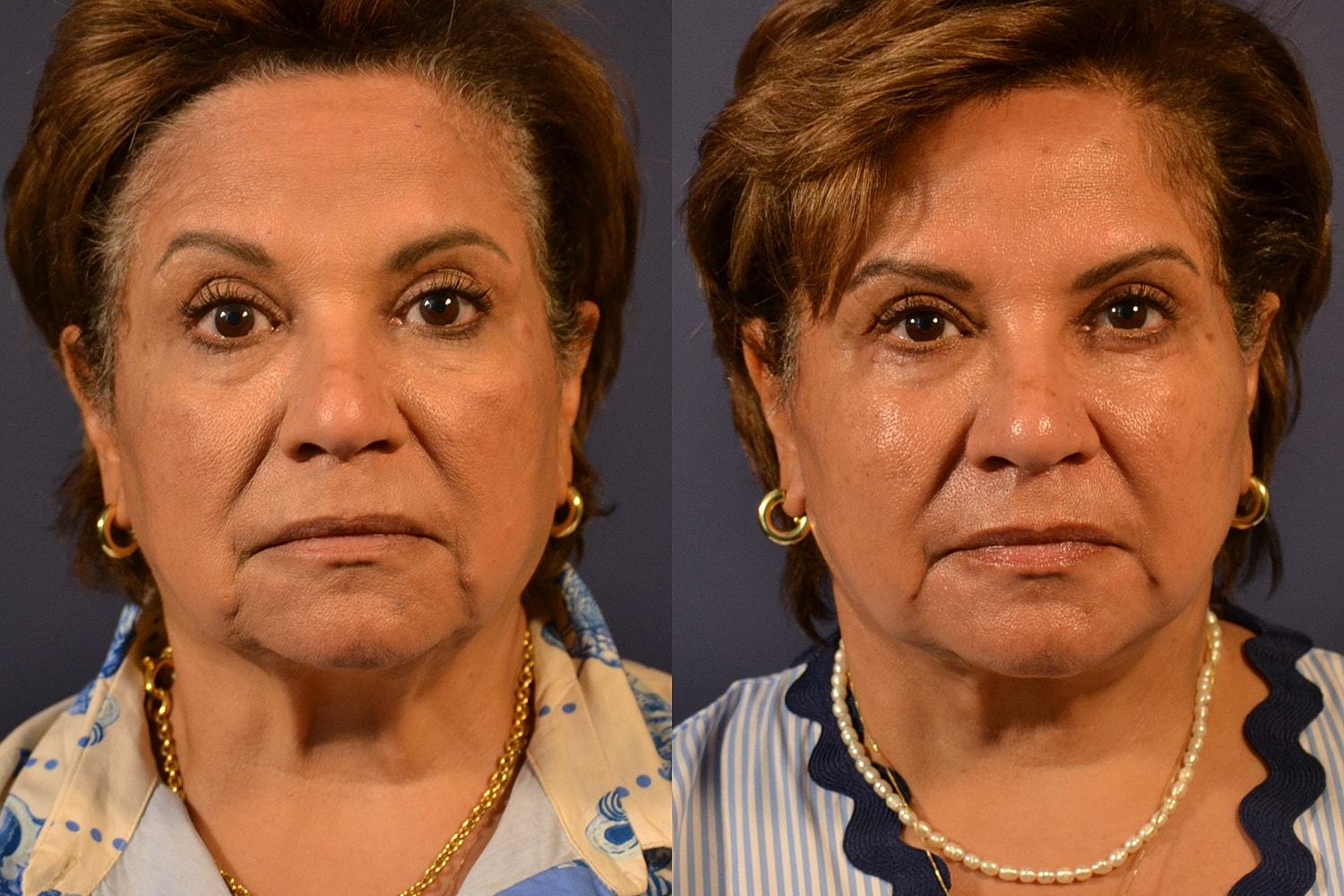 Facelift Before & After