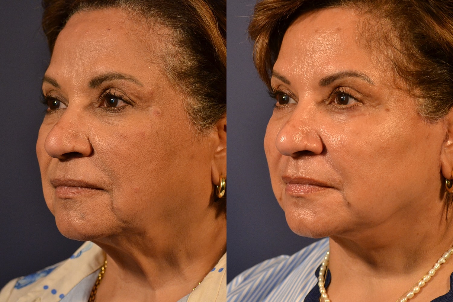 Facelift Before & After