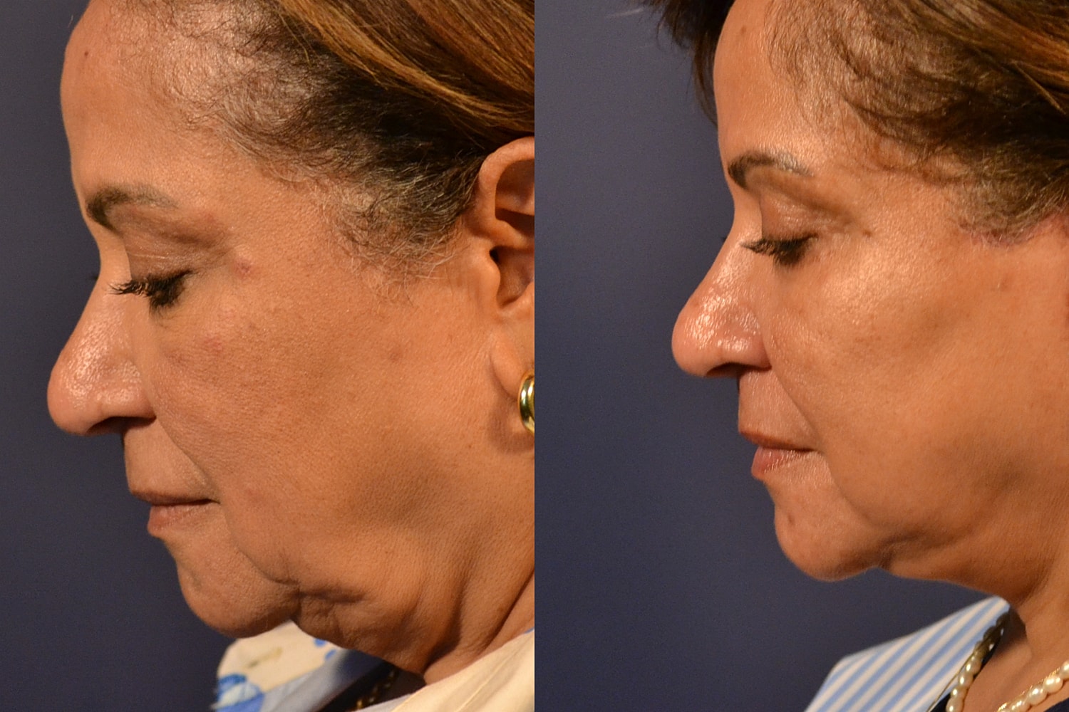 Facelift Before & After