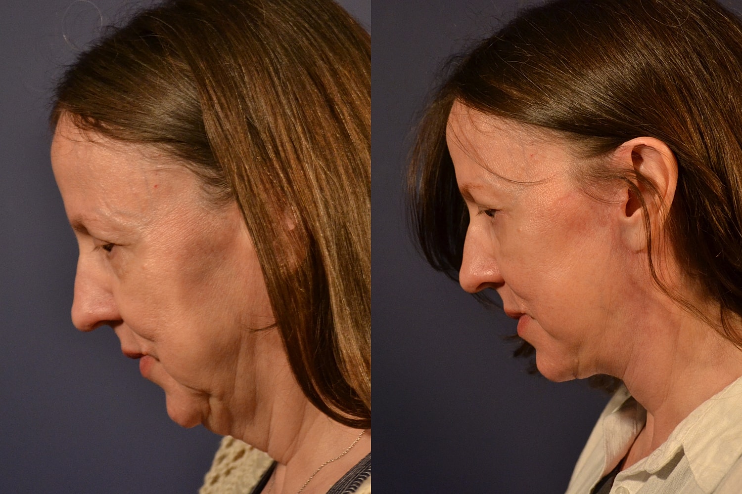 Facelift Before & After