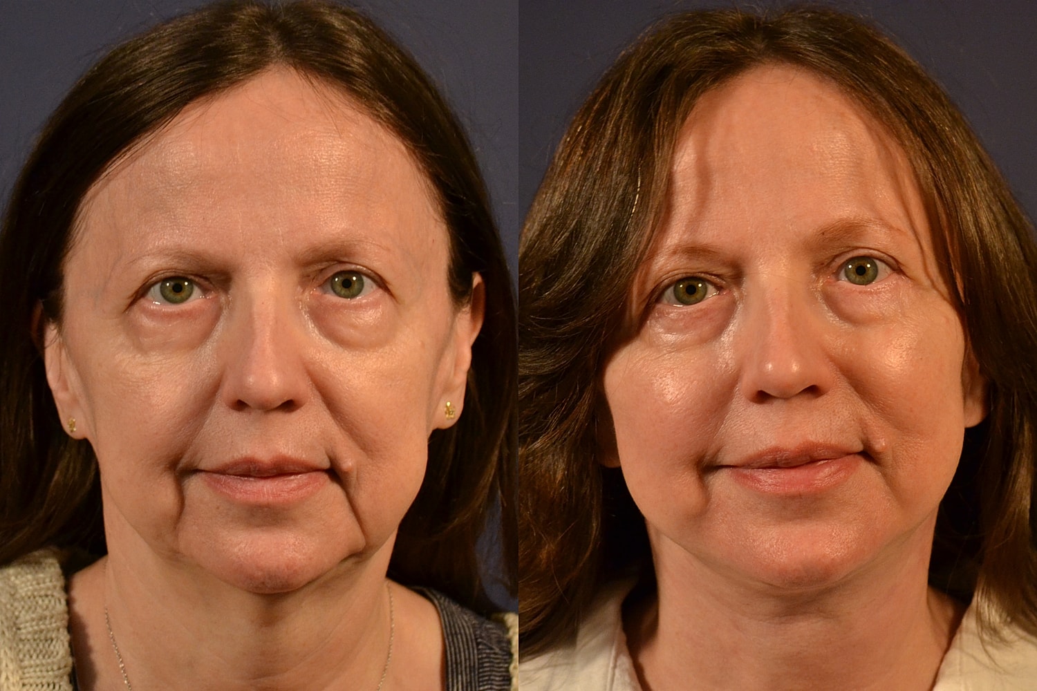 Facelift Before & After