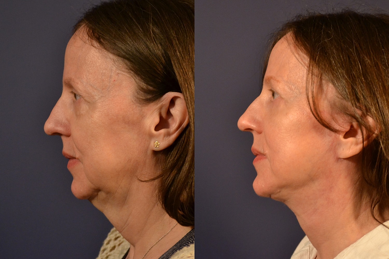 Facelift Before & After