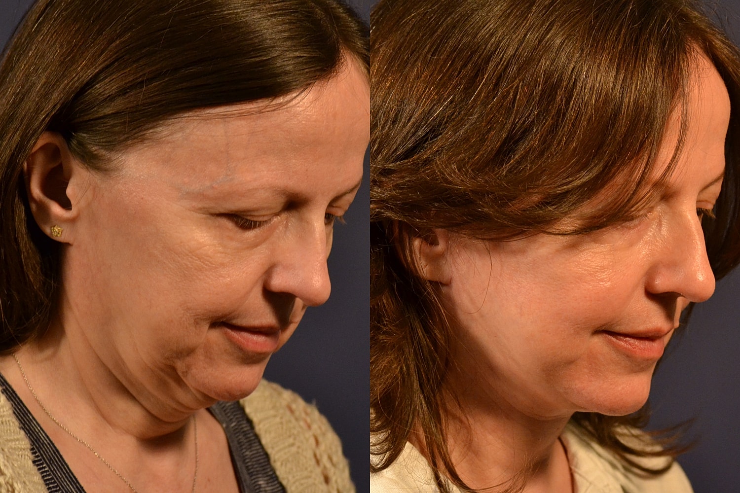 Facelift Before & After
