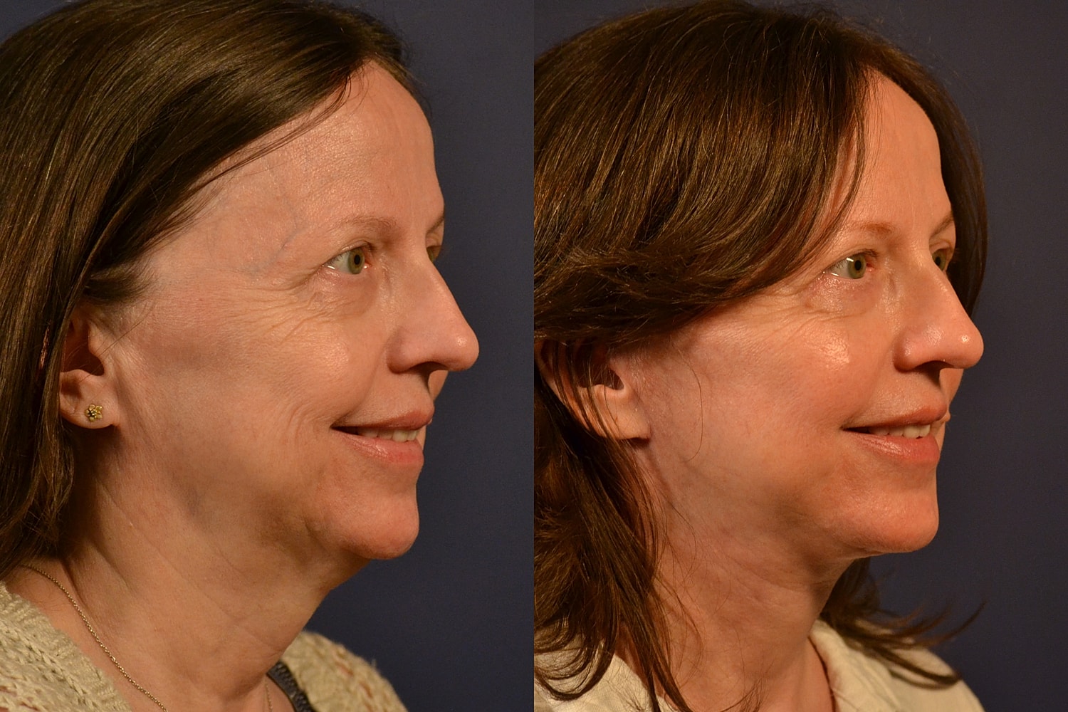 Facelift Before & After
