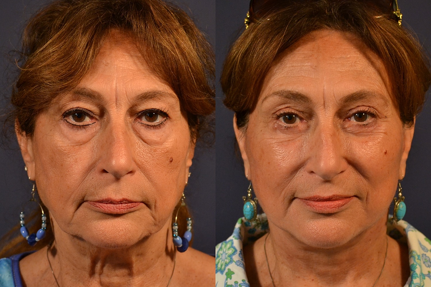 Woman with earrings, front-facing portraits.