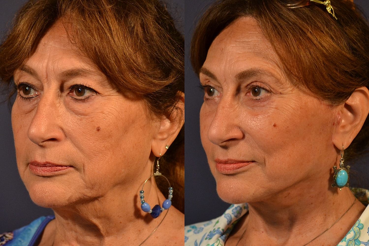 Woman with different earrings on either side.