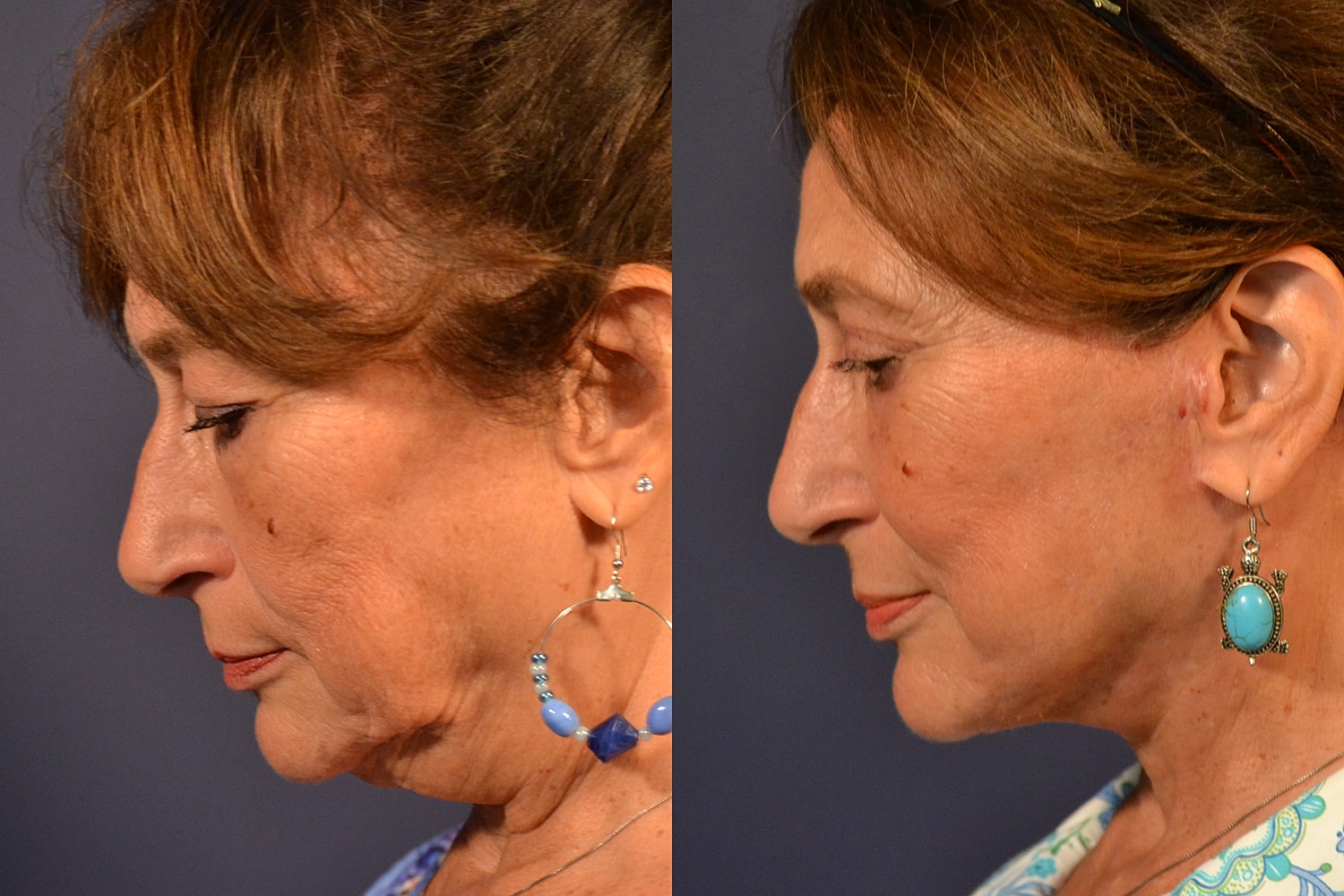 Profile comparison of woman with different earrings