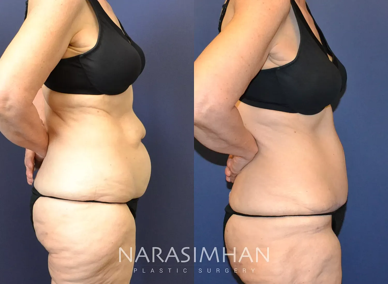 Liposuction Before & After