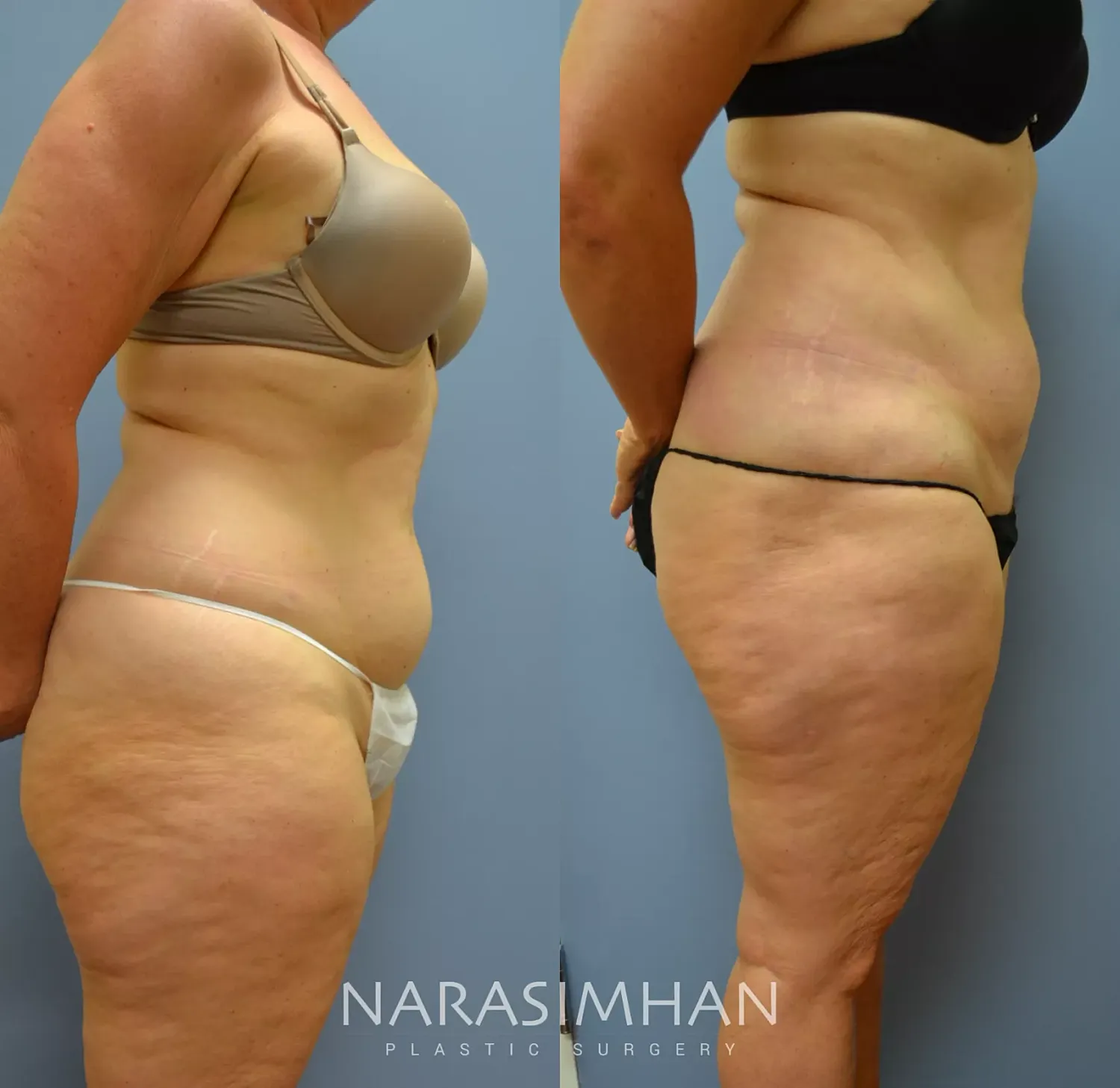 Liposuction Before & After
