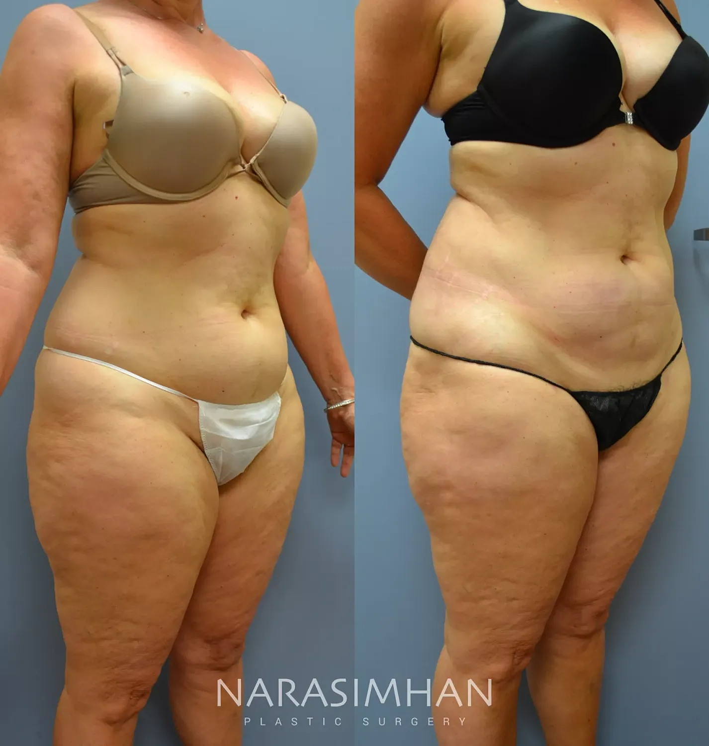 Liposuction Before & After