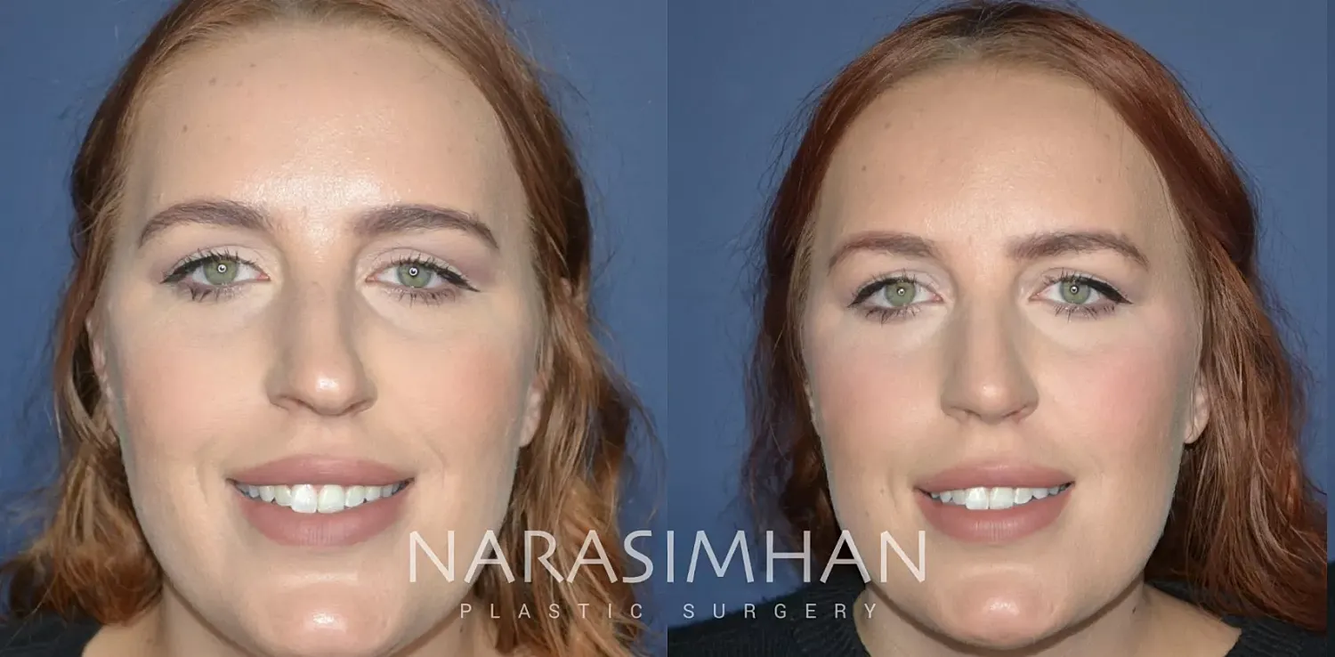 Liposuction Before & After