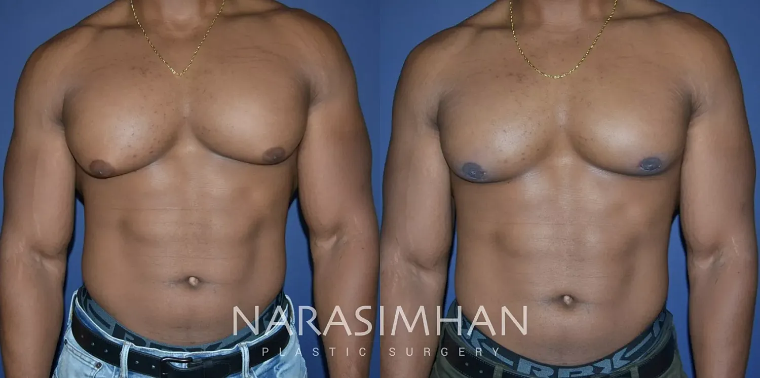 Liposuction Before & After
