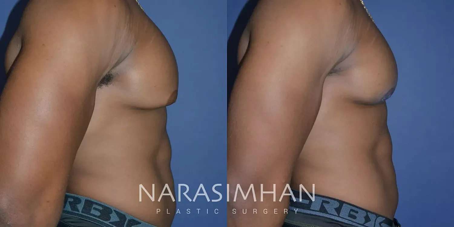 Liposuction Before & After