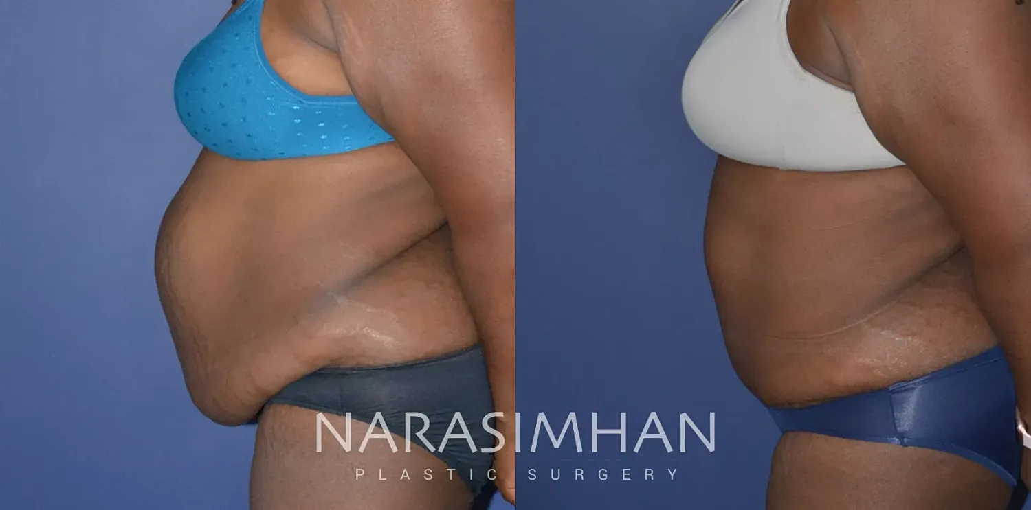 Liposuction Before & After
