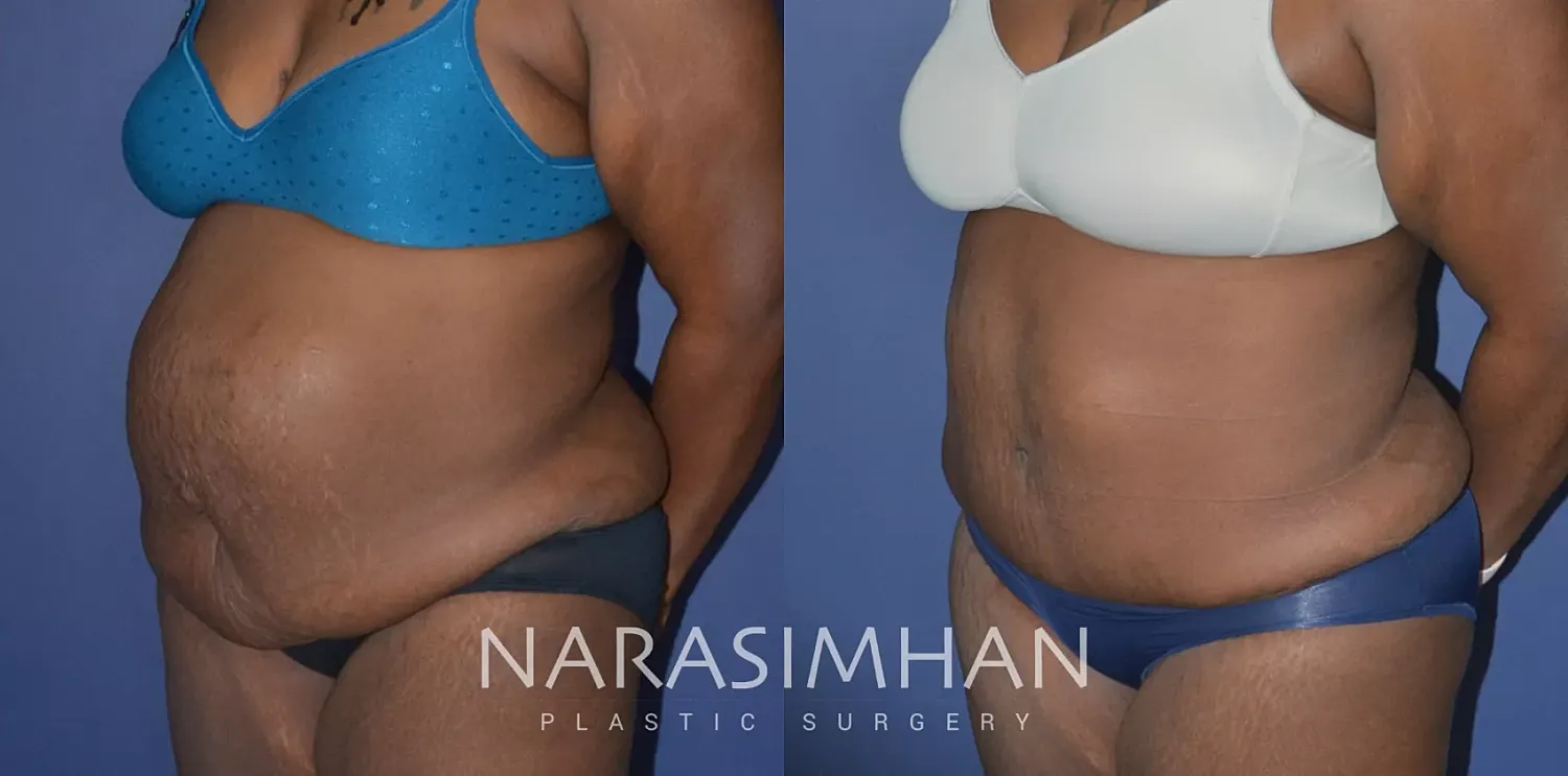 Liposuction Before & After