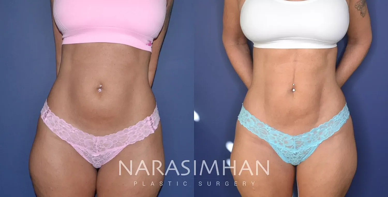 Liposuction Before & After