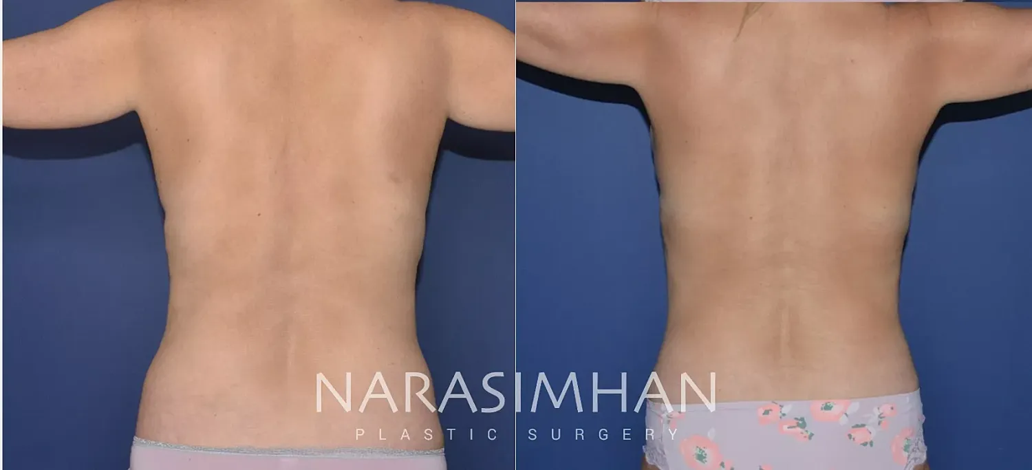 Liposuction Before & After