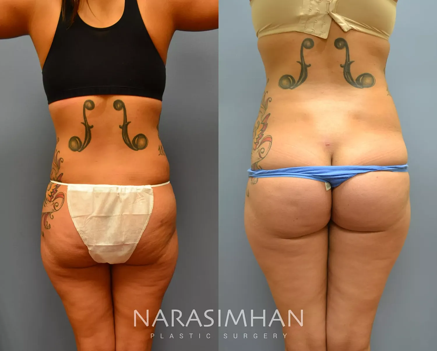 Liposuction Before & After