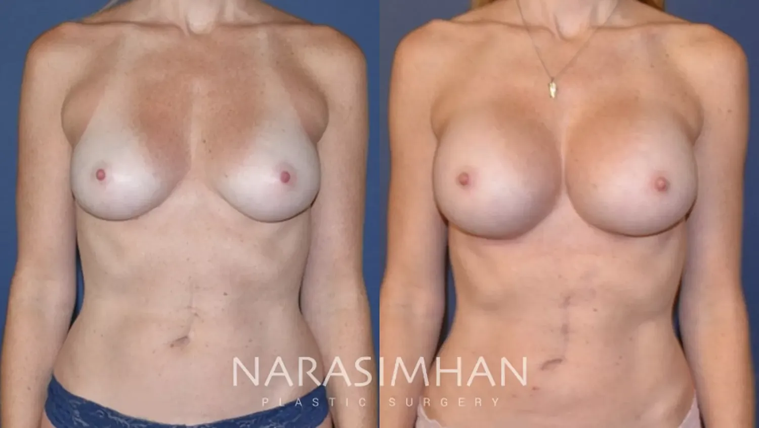 Liposuction Before & After
