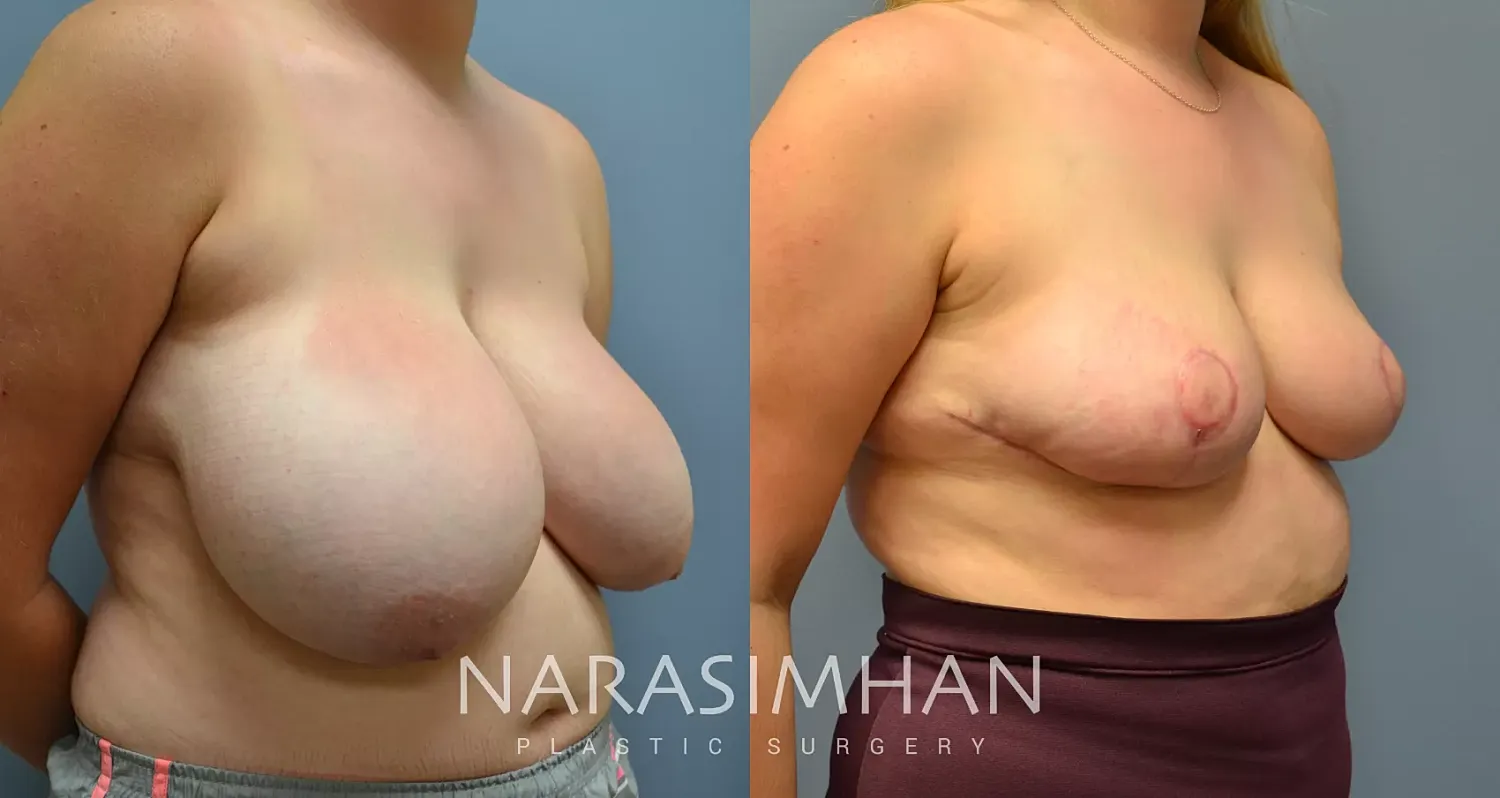 Breast Reduction Before & After